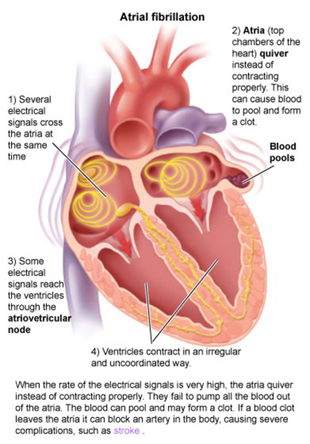 Atrial Fibrillation